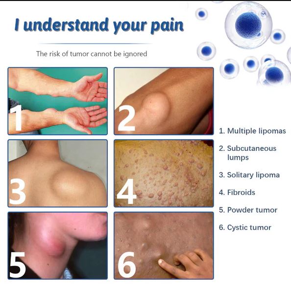 Doctor's No 1 choice | Lipoma Removal Cream (Pack of 2)
